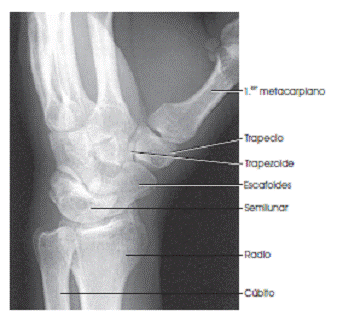 Proyección oblicua muñeca